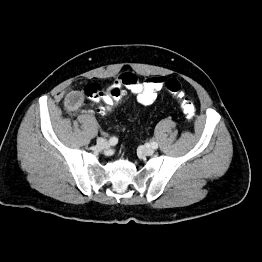 File:Acute appendicitis (Radiopaedia 77016-88960 Axial C+ portal venous phase 110).jpg