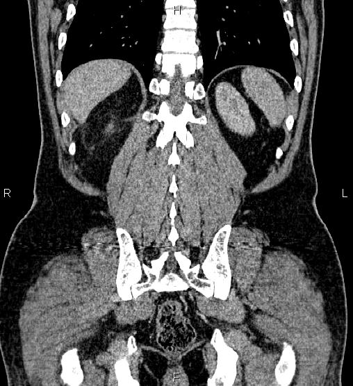 Acute appendicitis (Radiopaedia 84780-100240 Coronal C+ portal venous phase 67).jpg