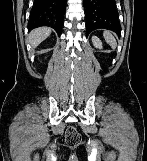Acute appendicitis (Radiopaedia 84780-100240 Coronal C+ portal venous phase 69).jpg