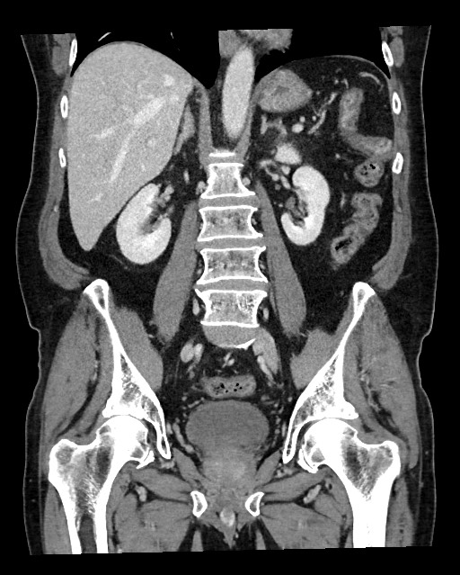 Acute appendicitis - large appendicoliths (Radiopaedia 61805-69820 Coronal C+ portal venous phase 80).jpg