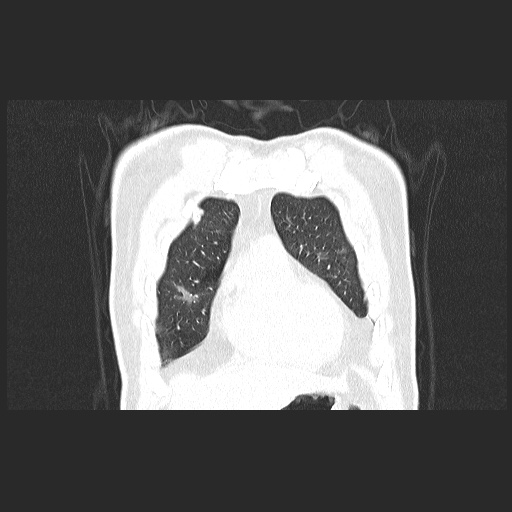 Acute appendicitis and COVID 19 pneumonia (Radiopaedia 76604-88380 G 14).jpg