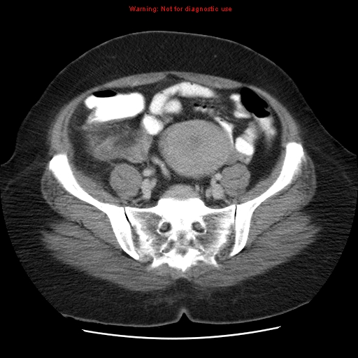 Acute appendicitis complicated by ovarian vein thrombophlebitis (Radiopaedia 16172-15851 Axial C+ portal venous phase 69).jpg