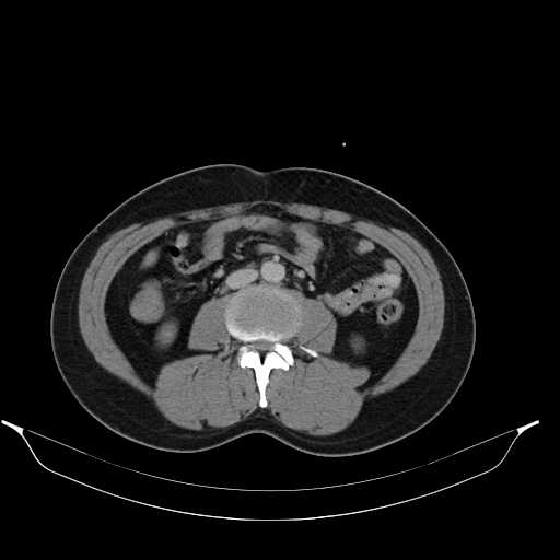 File:Acute appendicitis with appendicoliths (Radiopaedia 21148-21062 Axial C+ portal venous phase 1).jpg