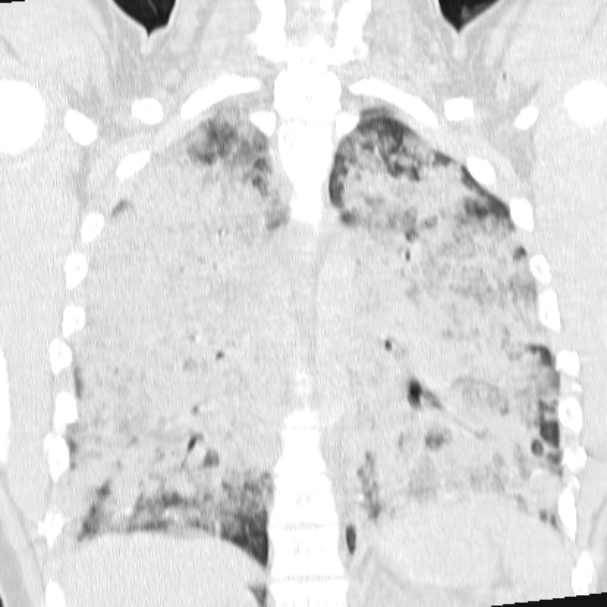 Acute aspiration pneumonitis (Radiopaedia 33605-34703 Coronal lung window 54).jpg