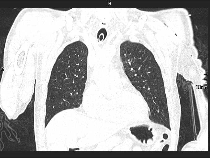 Acute aspiration pneumonitis (Radiopaedia 55642-62166 Coronal lung window 33).jpg