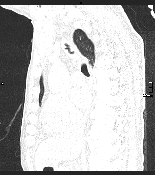 Acute aspiration pneumonitis (Radiopaedia 55642-62166 Sagittal lung window 85).jpg