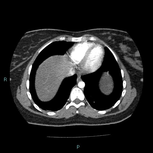 Acute bilateral pyelonephritis (Radiopaedia 37146-38881 Axial C+ arterial phase 6).jpg
