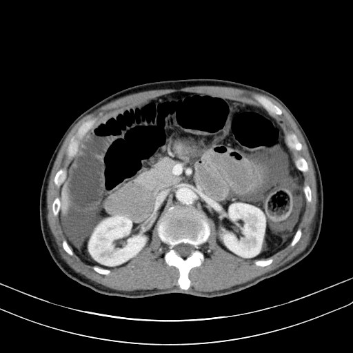 Acute bowel ischemia (Radiopaedia 87695-104114 Axial C+ portal venous phase 32).jpg