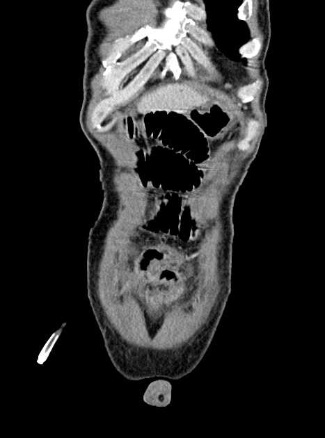Acute bowel ischemia (Radiopaedia 87695-104114 Coronal C+ portal venous phase 82).jpg