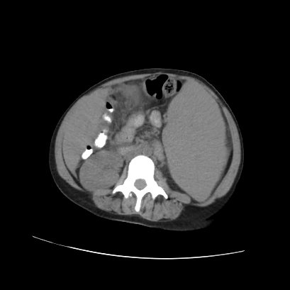 File:Acute calculous cholecystitis in patient with osteopetrosis (Radiopaedia 77871-90159 Axial non-contrast 45).jpg