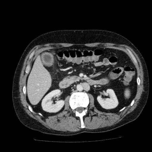 Acute cholecystitis and incidental left sided IVC (Radiopaedia 49352-54459 Axial C+ portal venous phase 67).jpg