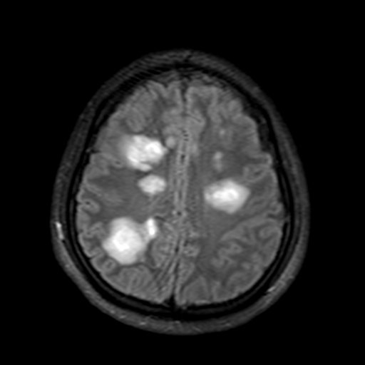 File:Acute disseminated encephalomyelitis (ADEM)- Anti-NMDA receptor encephalitis (Radiopaedia 54920-61198 Axial FLAIR post-GAD 17).png