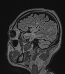 Acute disseminated encephalomyelitis (ADEM)- Anti-NMDA receptor encephalitis (Radiopaedia 54920-61201 Sagittal FLAIR 25).png