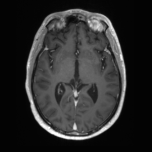Acute disseminated encephalomyelitis (ADEM) (Radiopaedia 65319-74350 Axial T1 C+ 28).png