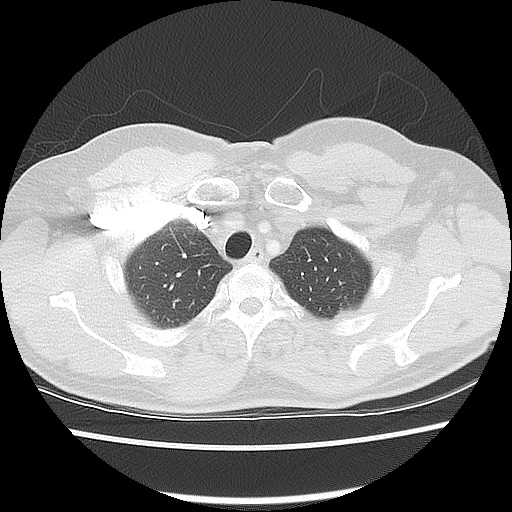 File:Acute epicardial fat necrosis (Radiopaedia 42327-45440 Axial lung window 14).jpg