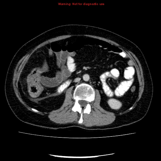 Acute gangrenous cholecystitis (Radiopaedia 10123-10661 Axial C+ portal venous phase 50).jpg