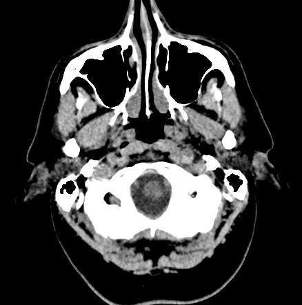 File:Acute internal carotid artery dissection (Radiopaedia 53541-59558 Axial non-contrast 5).jpg