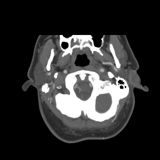 File:Acute internal carotid artery dissection (Radiopaedia 53541-59630 D 7).jpg