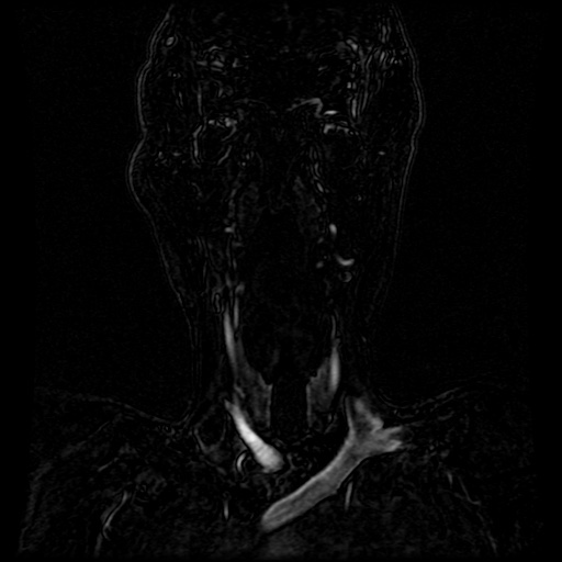 Acute internal carotid artery dissection (Radiopaedia 53541-59632 Coronal MRA 73).jpg