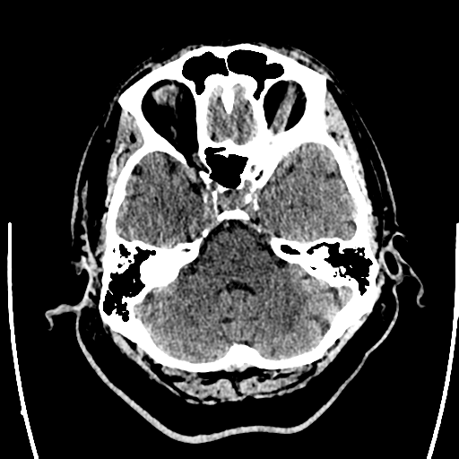 Acute left middle cerebral artery territory ischemic stroke (Radiopaedia 35688-37223 Axial non-contrast 18).png
