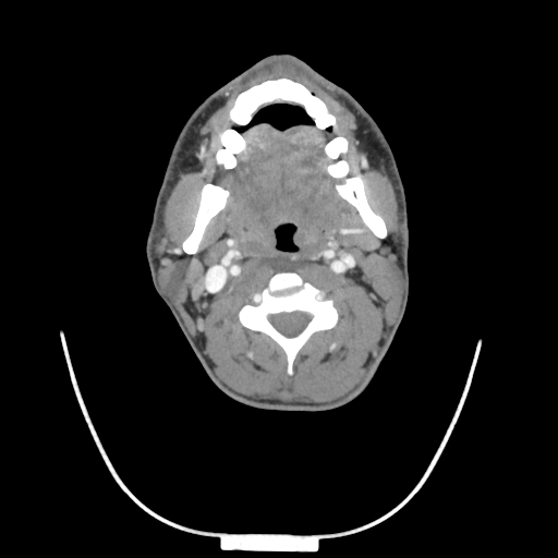Acute longus colli calcific tendinitis (Radiopaedia 72495-83036 Axial C+ arterial phase 36).jpg