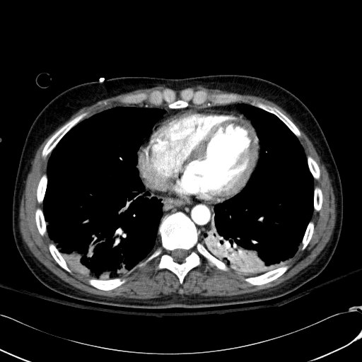 Acute myocardial infarction in CT (Radiopaedia 39947-42415 Axial C+ arterial phase 96).jpg