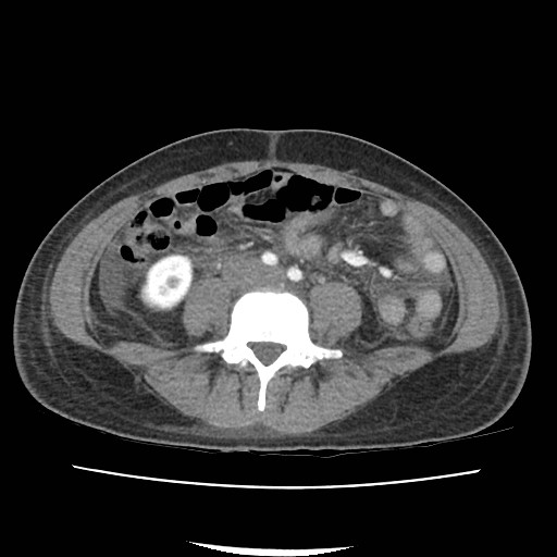 File:Acute myocarditis (Radiopaedia 55988-62613 Axial C+ portal venous phase 46).jpg