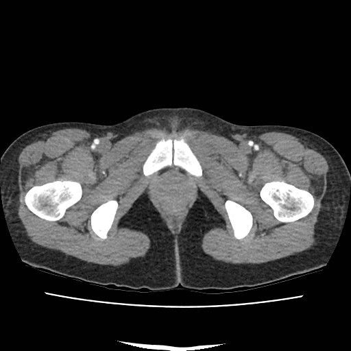 File:Acute myocarditis (Radiopaedia 55988-62613 Axial C+ portal venous phase 84).jpg