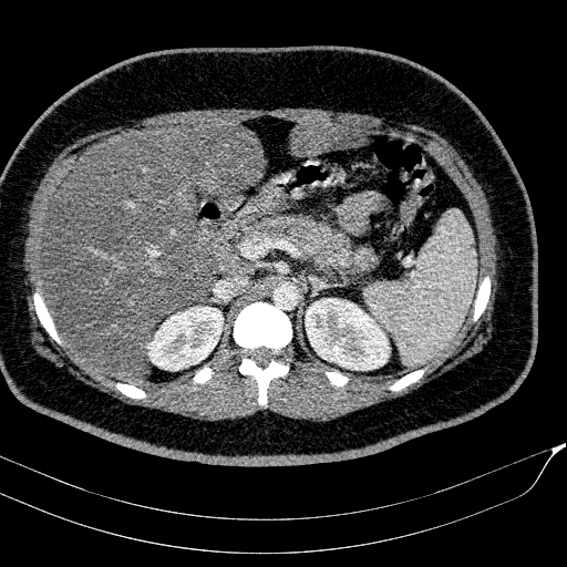 Acute on chronic pancreatitis (Radiopaedia 80902-94423 Axial C+ portal venous phase 50).jpg