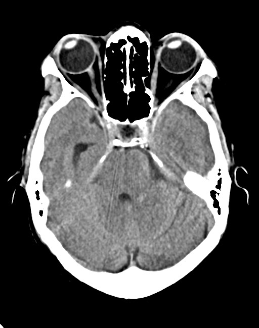 Acute on chronic subdural hematoma (Radiopaedia 74814-85823 Axial non-contrast 36).jpg