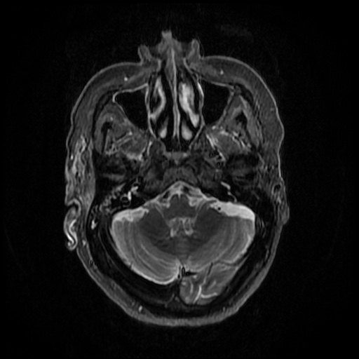 File:Acute otitis externa (Radiopaedia 57296-64236 Axial STIR 7).jpg