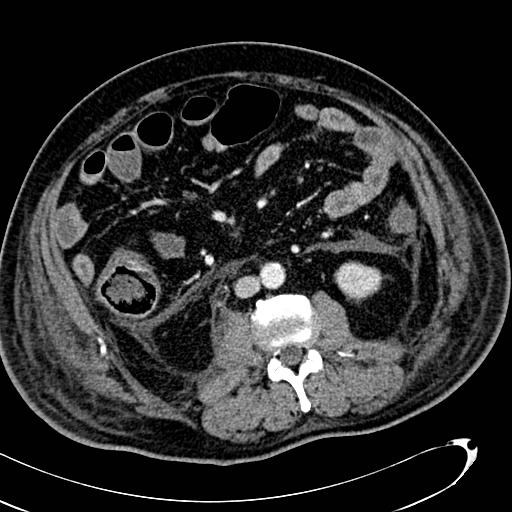 File:Acute pancreatic necrosis (Radiopaedia 13560-13486 Axial C+ portal venous phase 85).jpg