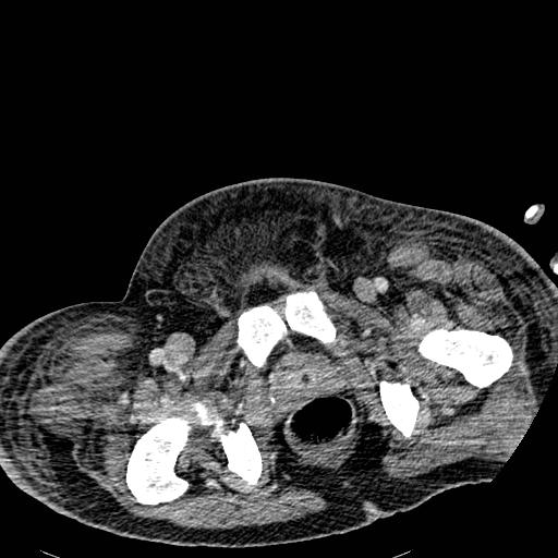 File:Acute pancreatic necrosis (Radiopaedia 13560-18501 Axial C+ portal venous phase 149).jpg