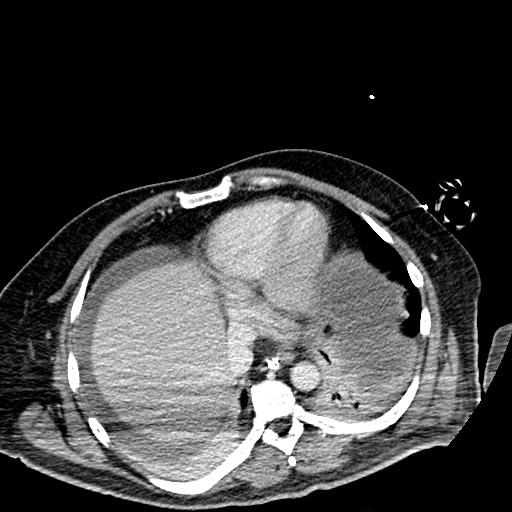 File:Acute pancreatic necrosis (Radiopaedia 13560-18501 Axial C+ portal venous phase 3).jpg
