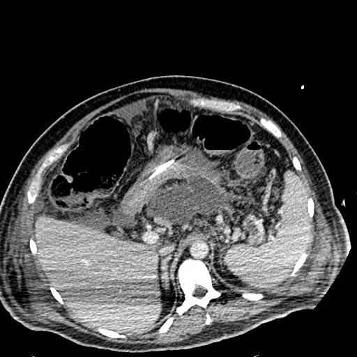 Acute pancreatic necrosis (Radiopaedia 13560-18501 Axial C+ portal venous phase 35).jpg