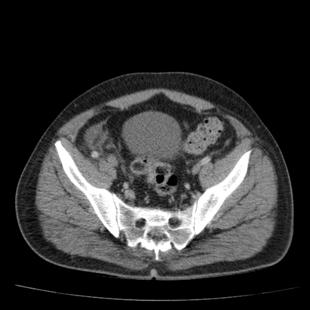Acute pancreatitis (Radiopaedia 26663-26813 Axial C+ portal venous phase 71).jpg