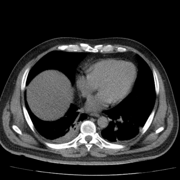 Acute pancreatitis (Radiopaedia 26663-26813 Axial non-contrast 10).jpg