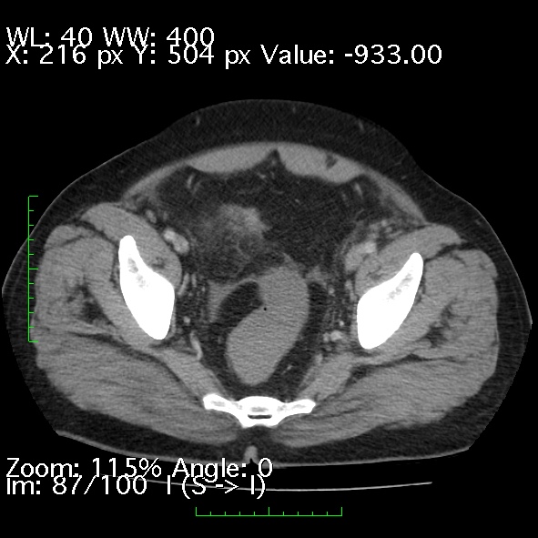 Acute pancreatitis (Radiopaedia 34043-35276 Axial C+ portal venous phase 87).jpg
