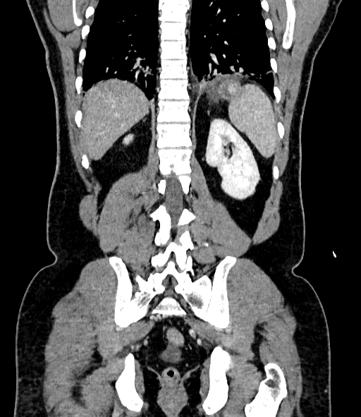 File:Acute pancreatitis (Radiopaedia 87428-103757 Coronal C+ portal venous phase 70).jpg