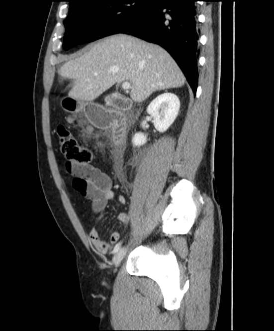 Acute pancreatitis - Balthazar E (Radiopaedia 23080-23110 Sagittal C+ portal venous phase 30).jpg