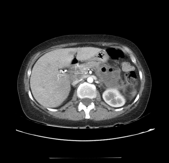 File:Acute pancreatitis - Balthazar E - post ERCP (Radiopaedia 27562-27772 Axial C+ arterial phase 18).png