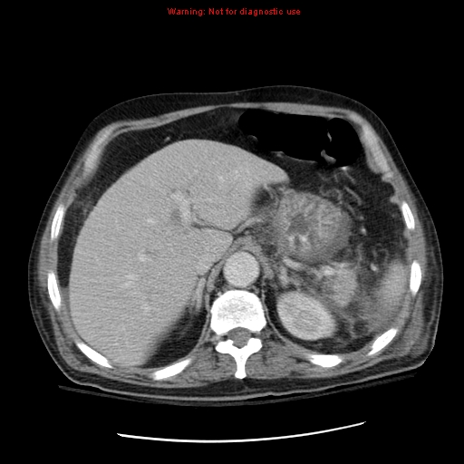 File:Acute pancreatitis with incidental pancreatic lipoma (Radiopaedia 10190-10730 Axial C+ portal venous phase 15).jpg