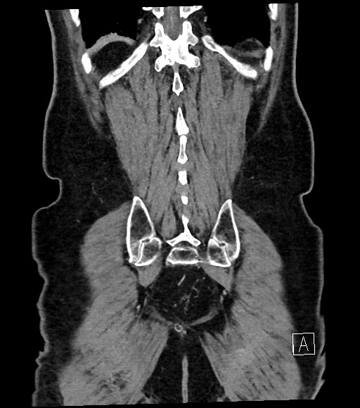 Acute renal infarction (Radiopaedia 59375-66736 Coronal C+ portal venous phase 55).jpg