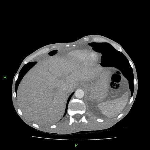 File:Acute right lung abscess (Radiopaedia 34806-36258 Axial C+ arterial phase 164).jpg