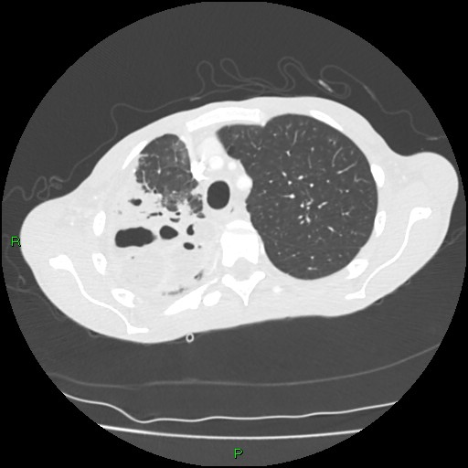 File:Acute right lung abscess (Radiopaedia 34806-36258 Axial lung window 44).jpg