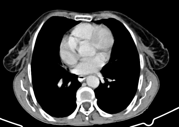 Acute small bowel (ileal) volvulus (Radiopaedia 71740-82139 Axial C+ portal venous phase 20).jpg