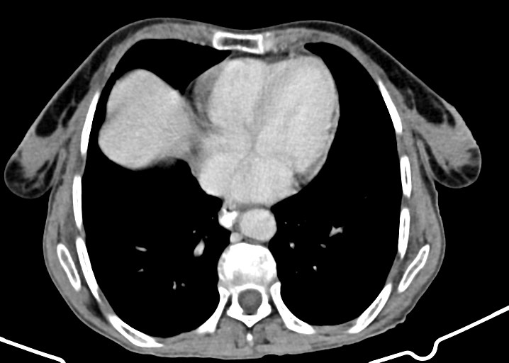 Acute small bowel (ileal) volvulus (Radiopaedia 71740-82139 Axial C+ portal venous phase 31).jpg