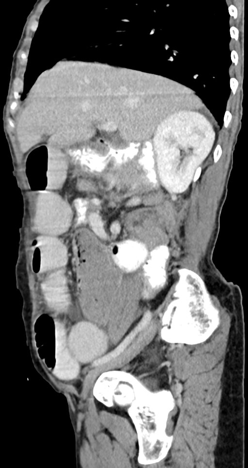 Acute small bowel (ileal) volvulus (Radiopaedia 71740-82139 Sagittal C+ portal venous phase 112).jpg