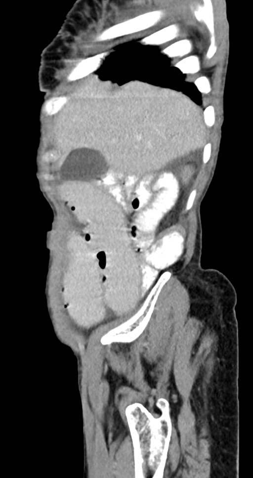 Acute small bowel (ileal) volvulus (Radiopaedia 71740-82139 Sagittal C+ portal venous phase 136).jpg