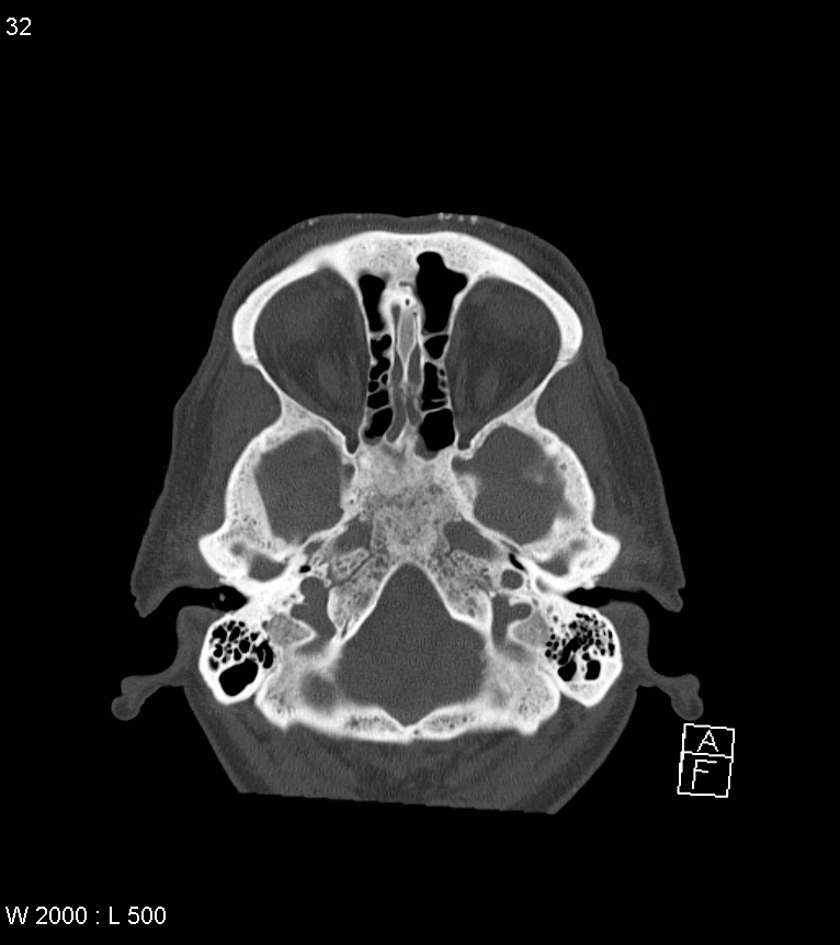 Acute subdural hematoma with myelofibrosis (Radiopaedia 52582-58494 Axial bone window 16).jpg